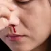 Summer Nose Bleeding Prevention Tips