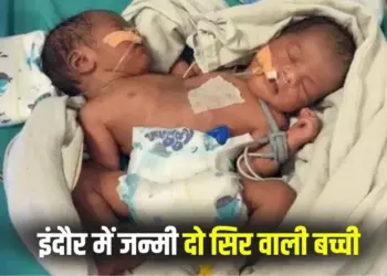 Indore Conjoined Twins