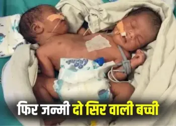 Indore Conjoined Twins