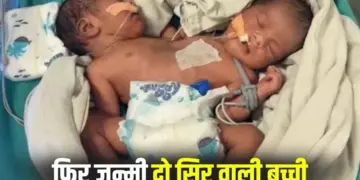 Indore Conjoined Twins