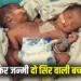 Indore Conjoined Twins