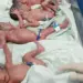 Bhopal Quadruplet Birth