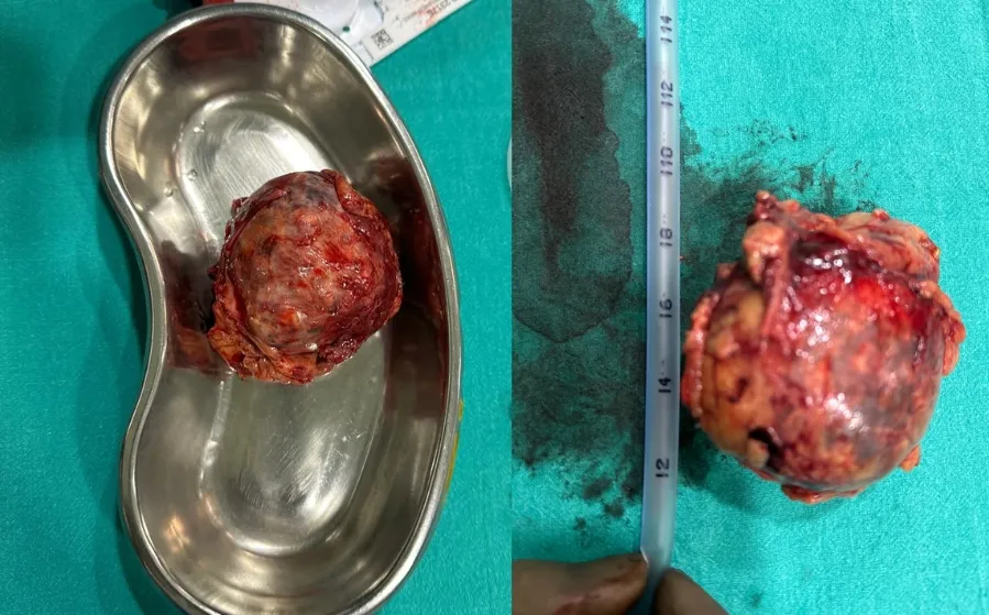 Tumor