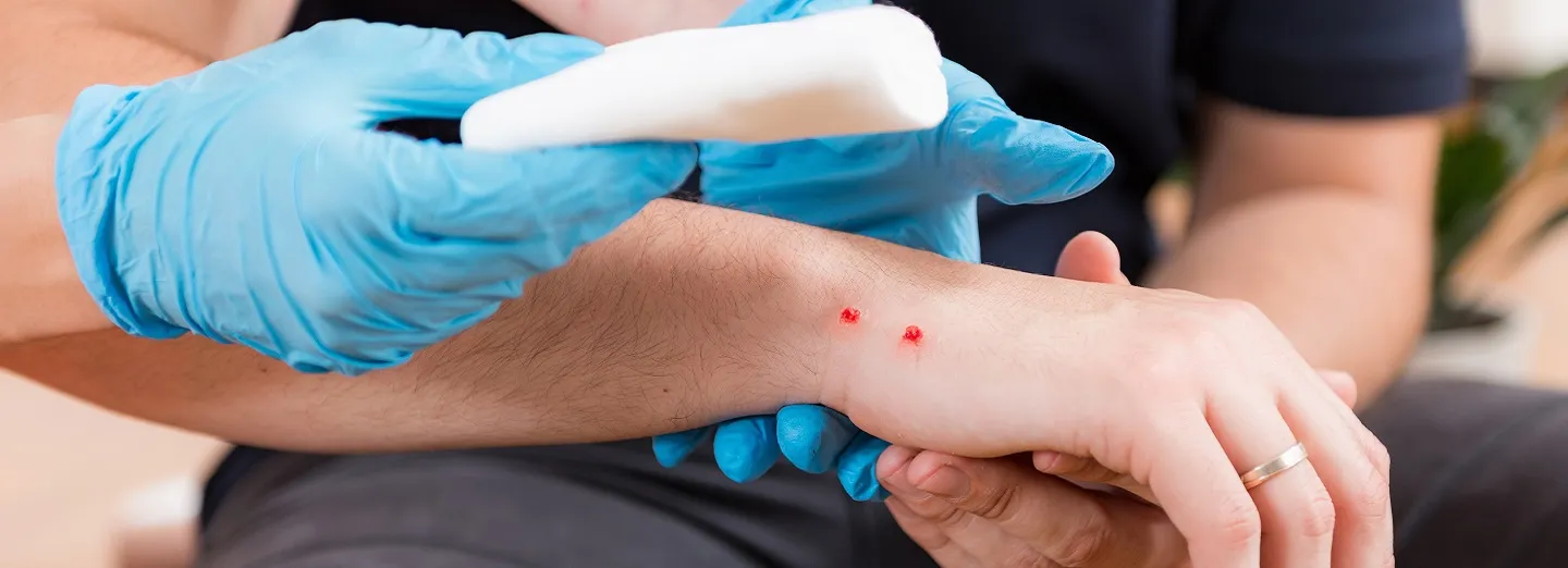 snakebite first aid