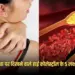 High Cholesterol Skin Symptoms